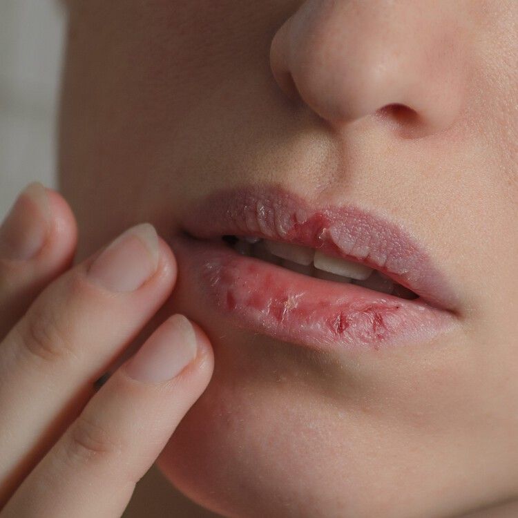 Dry Lips During Winter: Why It Happens & How Honey Can Help